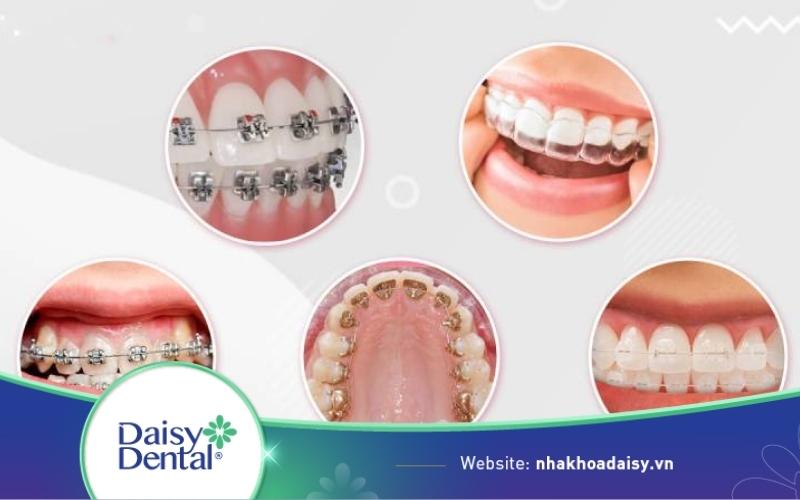 Điều trị khớp cắn ngược bao nhiêu tiền