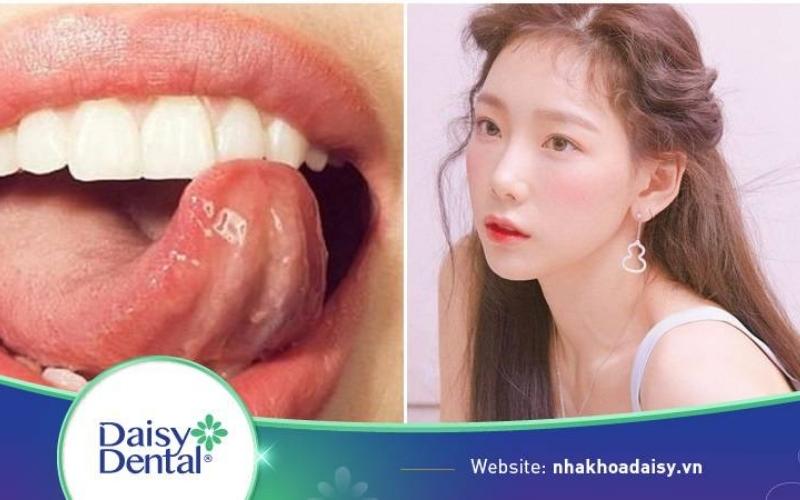 Khớp cắn ngược có nên tập mewing không