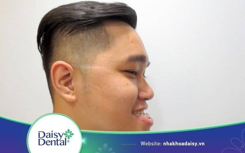 Khớp cắn ngược loại 3