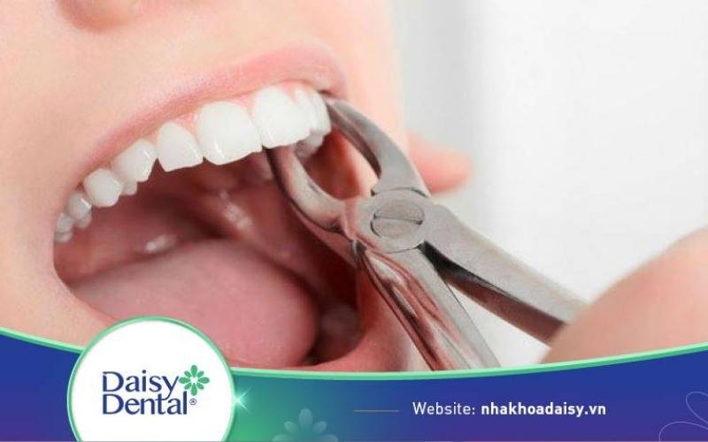 Niềng răng móm có phải nhổ răng không