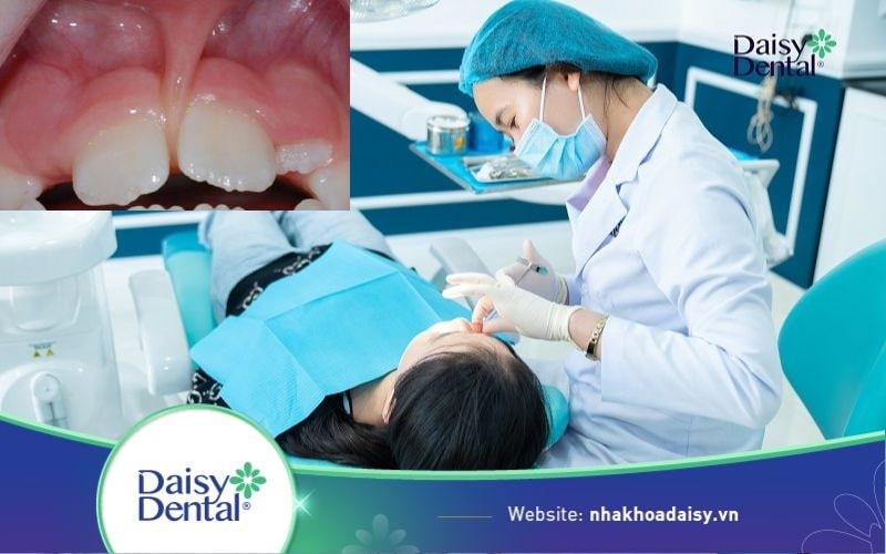 Phanh môi bám thấp
