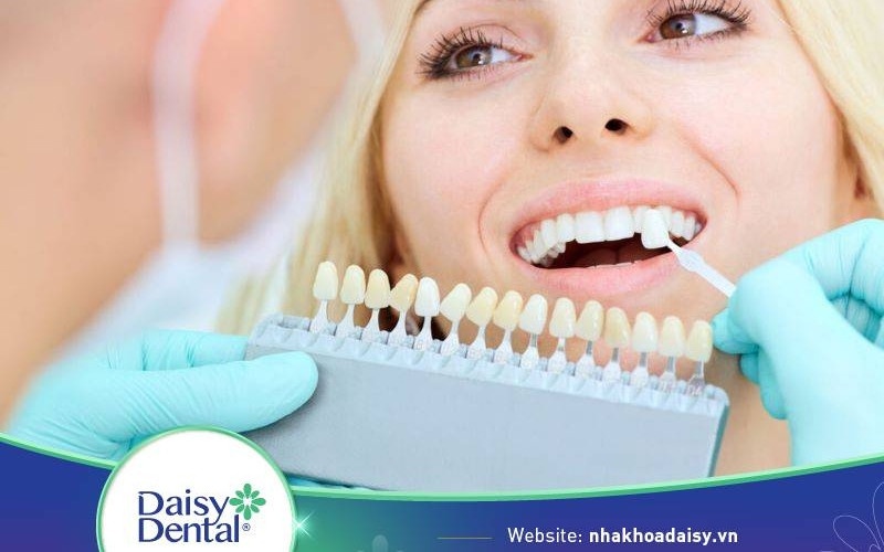 quy trình dán sứ veneer