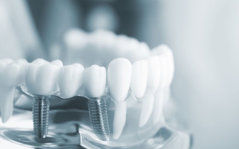 Implant khắc phục được nhược điểm của cầu răng sứ