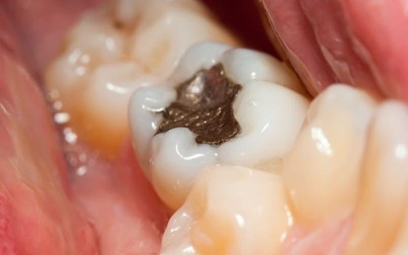 Trám răng cấm giúp khắc phục hiện tượng răng bị bể