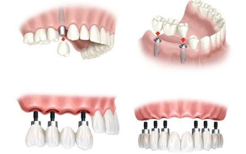 Trồng răng implant gồm nhiều kỹ thuật khác nhau