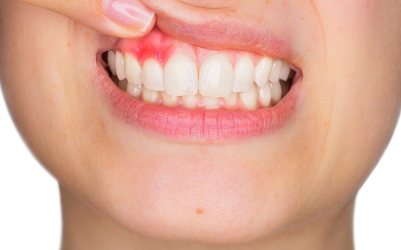 Viêm nướu có thể gây mất răng vĩnh viễn