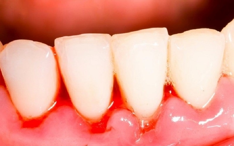 Bệnh viêm nướu do cách vệ sinh răng miệng không hiệu quả