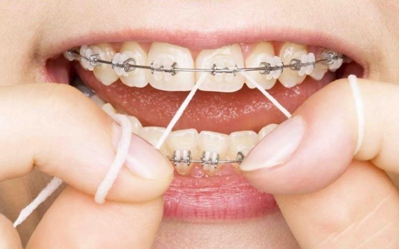 Ăn các loại thức ăn cứng, dai khi niềng răng dễ khiến cho khí cụ chỉnh nha bị tuột