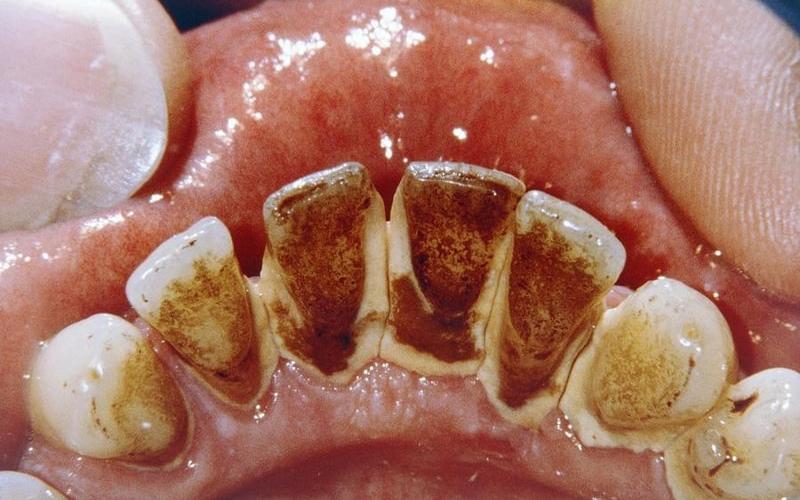 Cao răng làm mất thẩm mỹ và gây ra nhiều biến chứng nguy hiểm