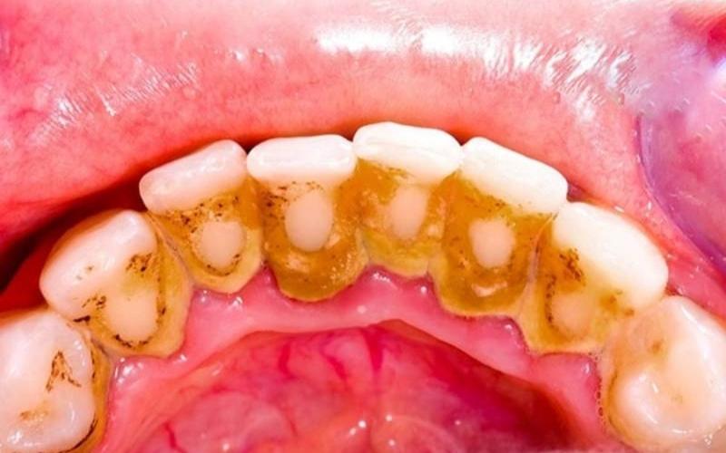 Cao răng kết dính với bề mặt răng