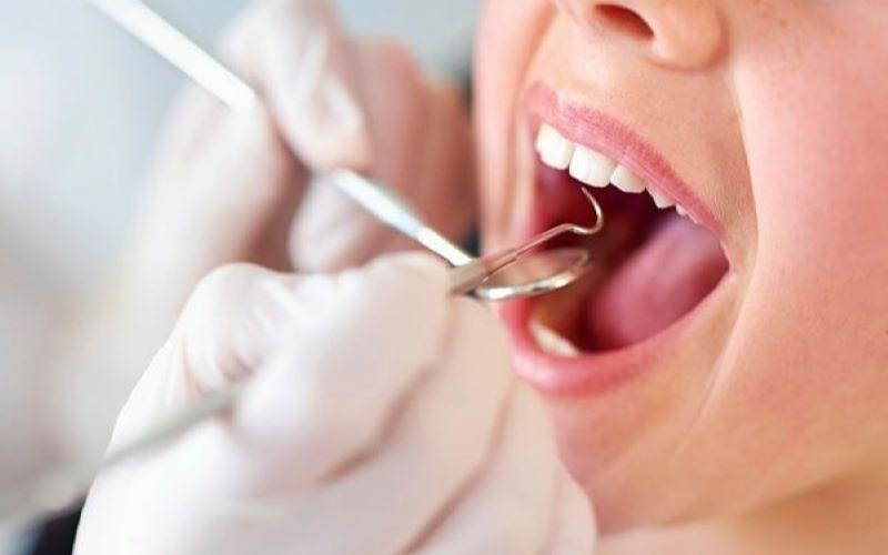 Không nên lạm dụng việc lấy cao răng