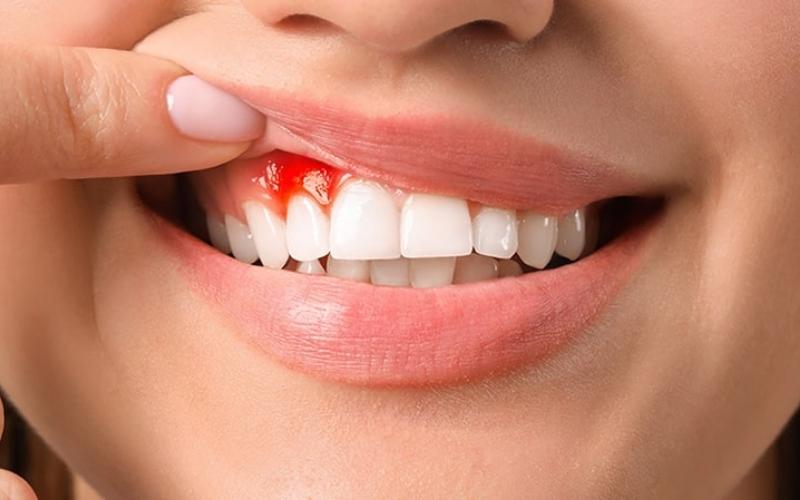 Lợi ở chân răng bị rách do nhiều nguyên nhân gây ra