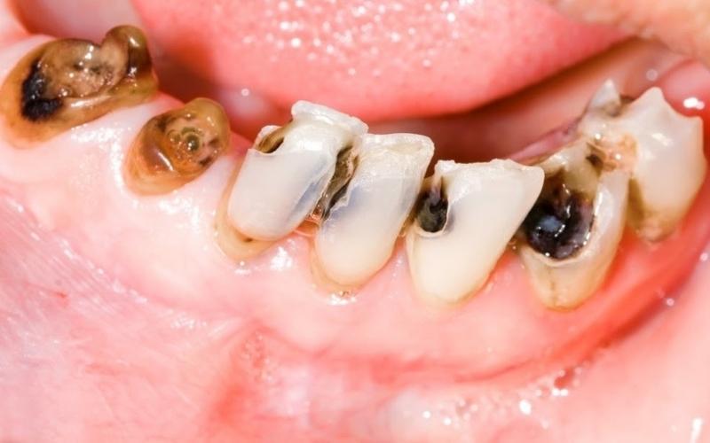 Răng bị lệch khớp cắn nhẹ để lâu có nguy cơ bị sâu răng