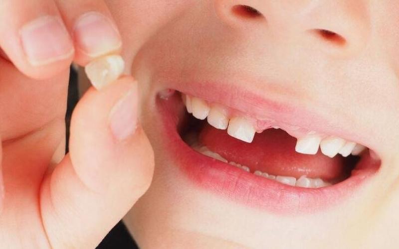 Nhổ răng sữa để tạo chỗ trống cho răng vĩnh viễn mọc