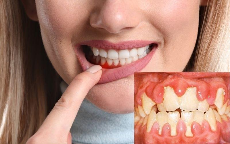 Viêm lợi trùm răng cửa là gì? Tác hại và cách điều trị
