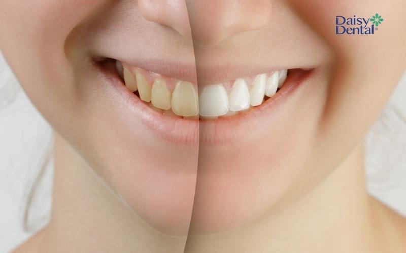 Tẩy trắng răng giúp răng trắng sáng thẩm mỹ