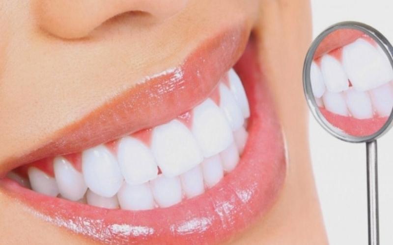 Tẩy trắng răng áp dụng cho các trường hợp răng bị nhiễm màu nhẹ