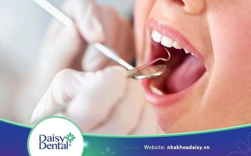 Bao lâu lấy cao răng 1 lần