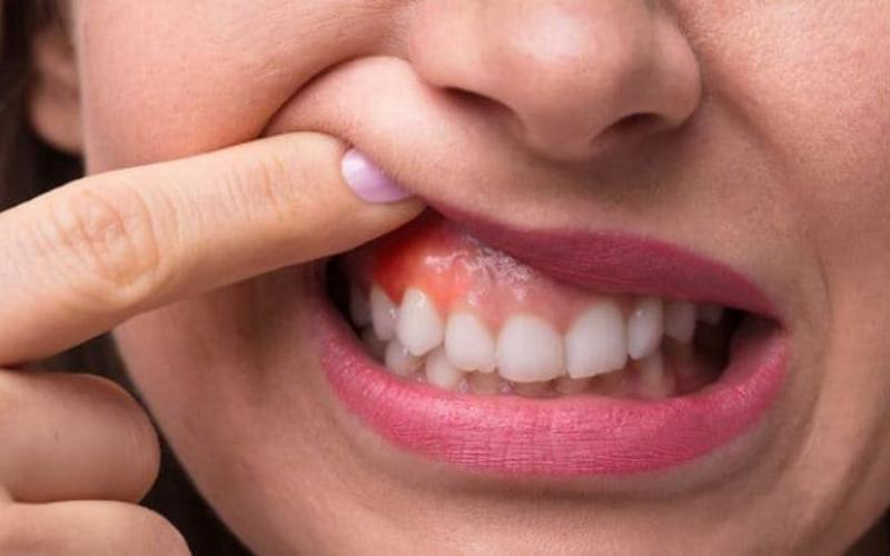 Viêm chân răng có mủ gây ra nhiều biến chứng nguy hiểm cho sức khỏe răng miệng trong tương lai