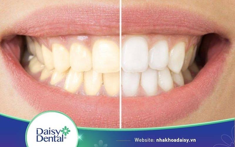 tẩy trắng răng có bị vàng lại không