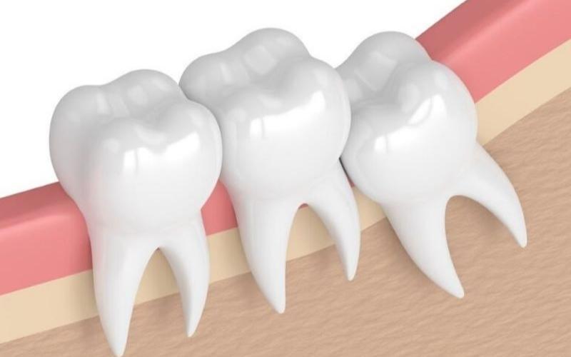Tùy thuộc vào tình trạng răng miệng mà vết thương của bạn có nhanh hồi phục hay không
