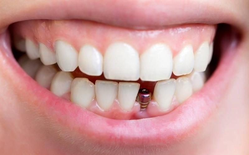 Trồng răng Implant là giải pháp phục hình răng bị mất tốt nhất hiện nay