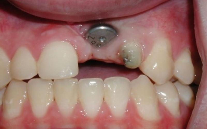 Trồng răng Implant tại vị trí răng hàm gần với các dây thần kinh sẽ đau nhiều hơn tại vị trí khác