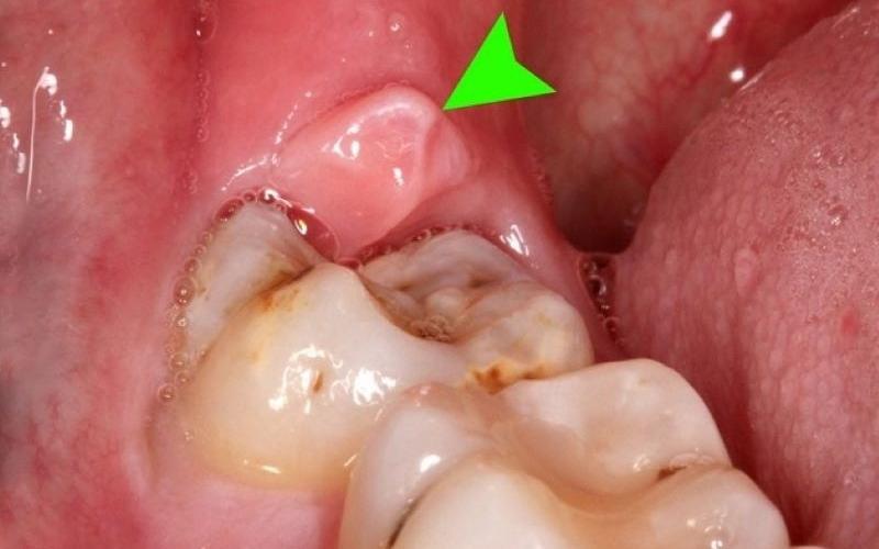 Viêm lợi trùm răng khôn gây ra nhiều biến chứng nguy hiểm đến sức khỏe