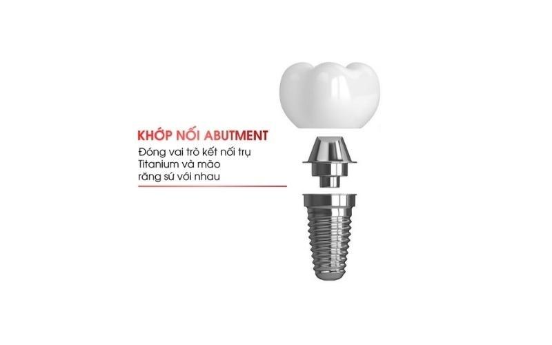 Abutment Implant là bộ phận không thể thiếu để hoàn thiện răng Implant