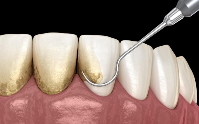 Cạo vôi răng là phương pháp điều trị sưng lợi hiệu quả, được thực hiện tại nha khoa
