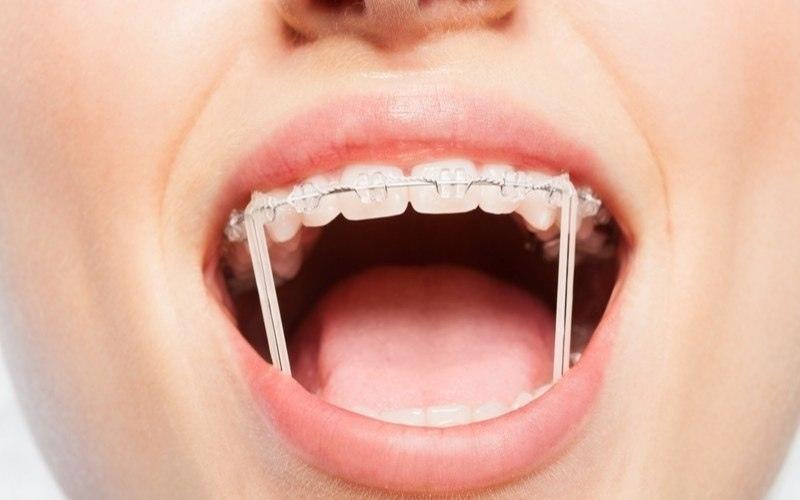 Thun liên hàm giúp điều chỉnh răng xô lệch về đúng vị trí