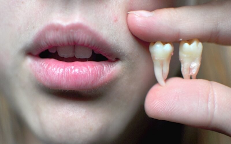 Khi nào nên nhổ răng khôn?