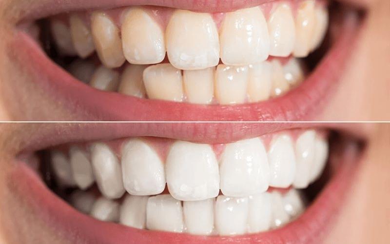 Không nên lạm dụng tẩy trắng răng