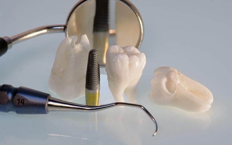 Nhổ răng khôn hàm dưới nguy hiểm hơn so với hàm trên