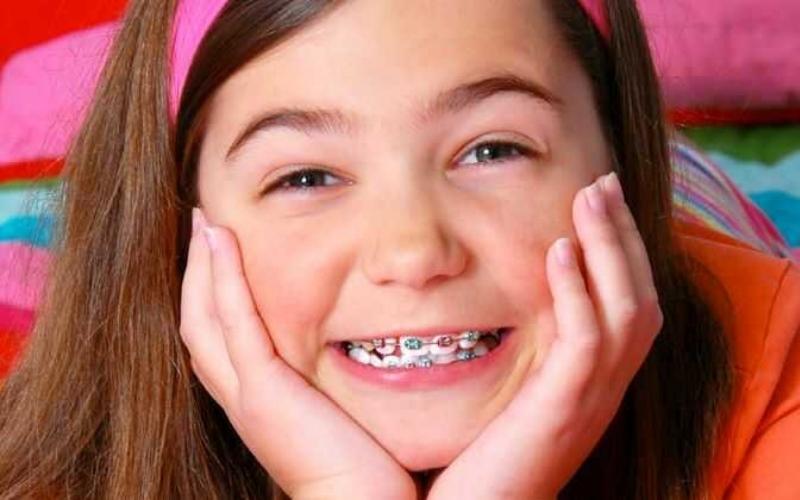 Nên niềng răng từ sớm để cải thiện khớp cắn ngược ở trẻ