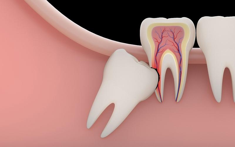 Răng khôn mọc lệch gây đau nhức và ảnh hưởng đến răng bên cạnh
