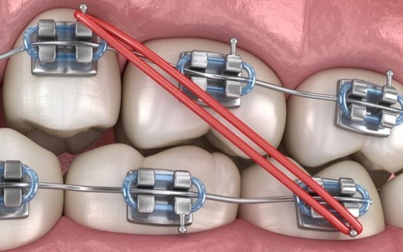 Thun liên hàm được mắc ở răng cối thứ hai của hàm trên