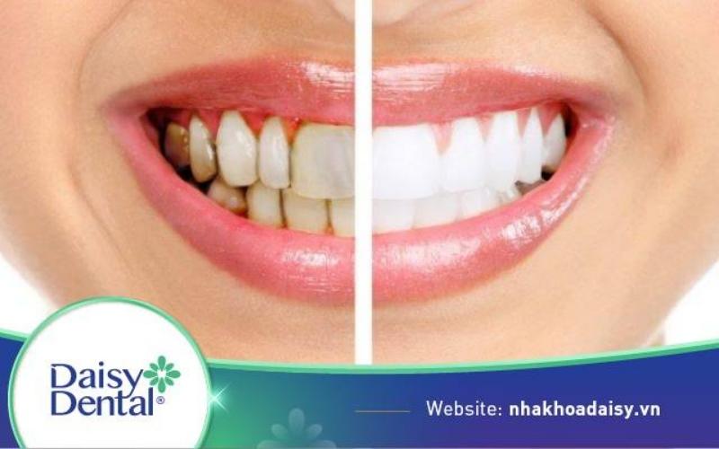 Răng giả có tẩy trắng được không