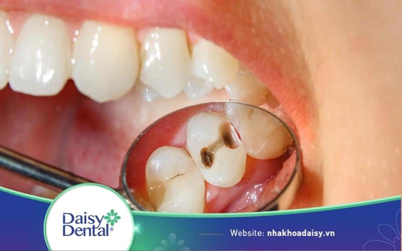 răng sâu có tẩy trắng được không