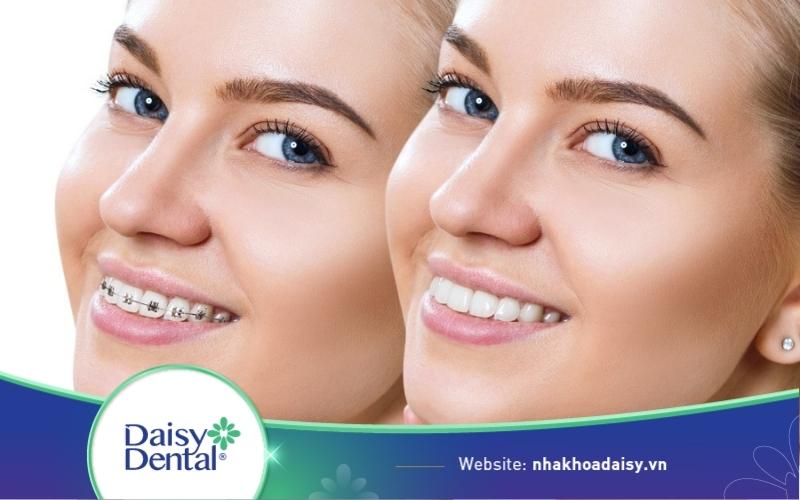 tẩy trắng răng sau khi niềng