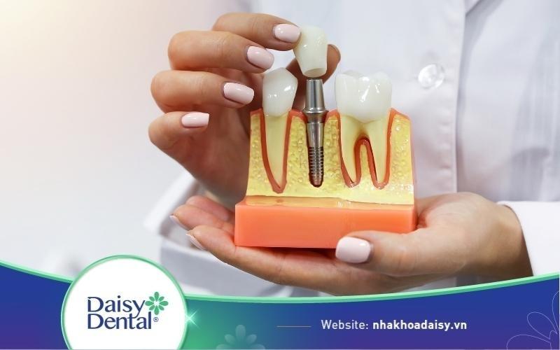 trồng răng implant mất bao lâu