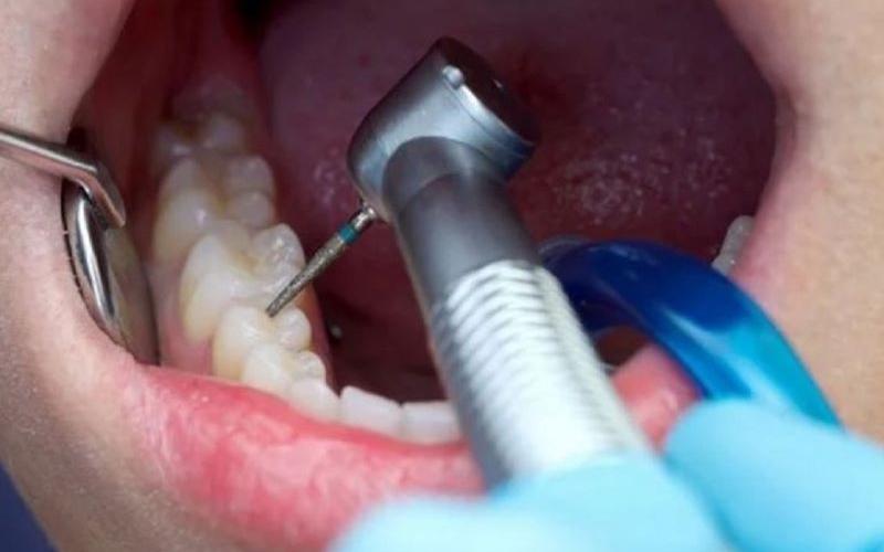 Trám răng là quá trình sử dụng các vật liệu nhân tạo để bổ sung vào phần mô răng bị thiếu