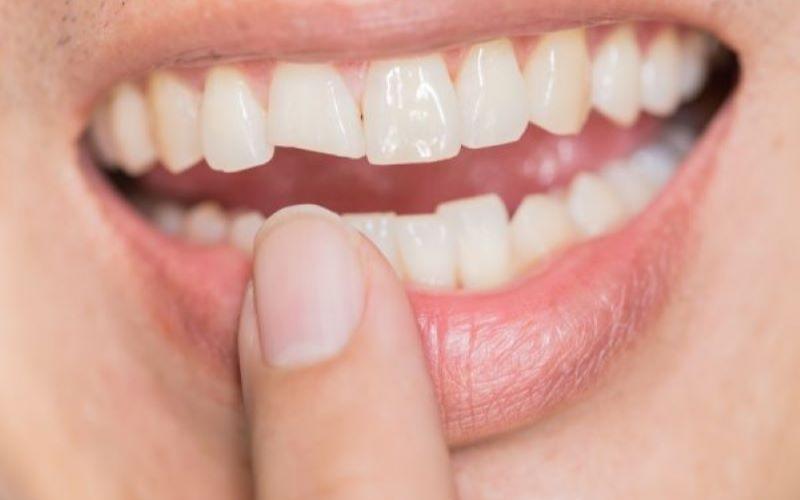 Răng mẻ vỡ có thể trám răng để cải thiện