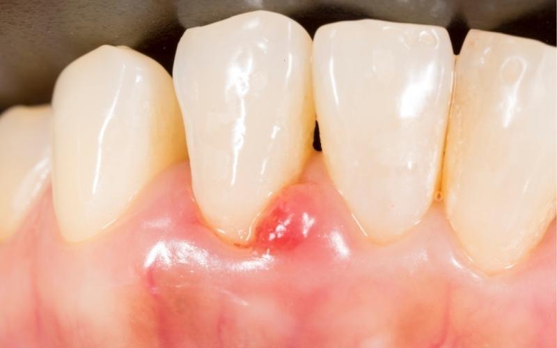 Lấy cao răng là kỹ thuật bắt buộc phải thực hiện nếu muốn điều trị viêm lợi