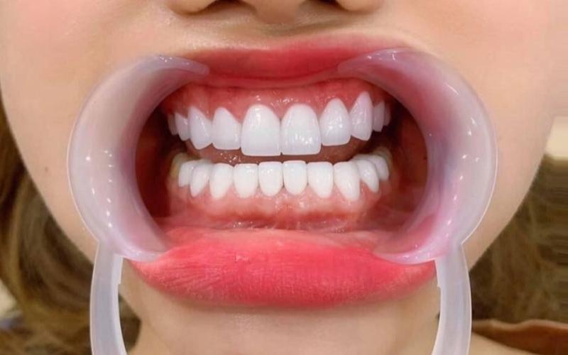 Phương pháp bọc răng sứ