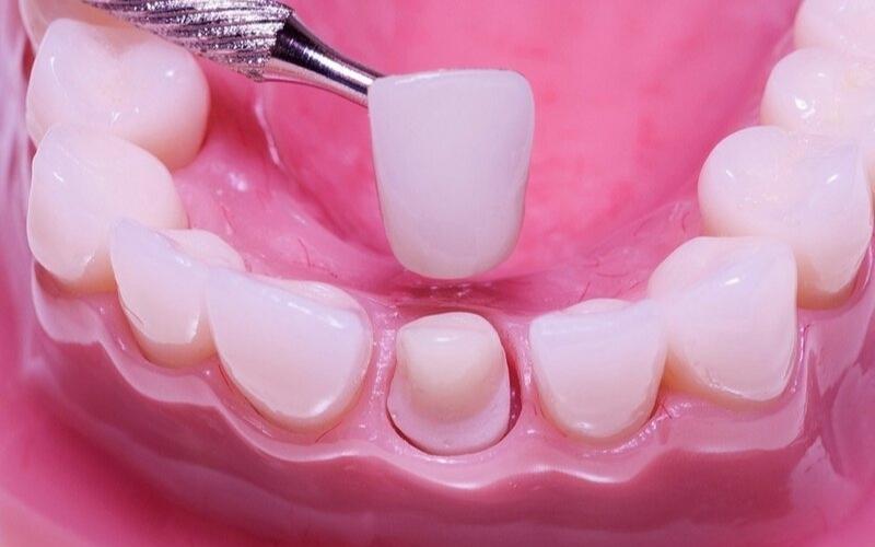 Bọc răng sứ là phương pháp bảo vệ răng có hiệu quả lâu dài
