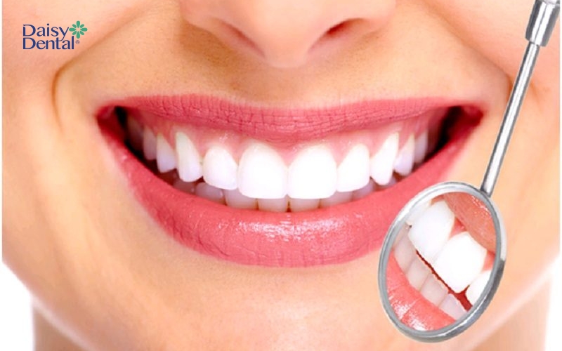 Cạo vôi răng và tẩy trắng răng là hai phương pháp khác nhau