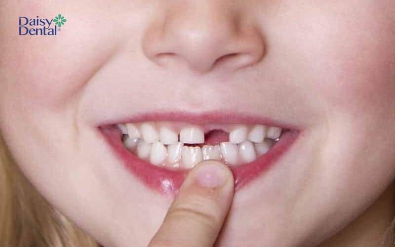 Phụ huynh nên đưa con đến nha sĩ để thay răng