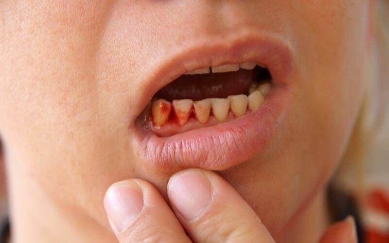 Nướu răng bị tổn thương, chảy máu