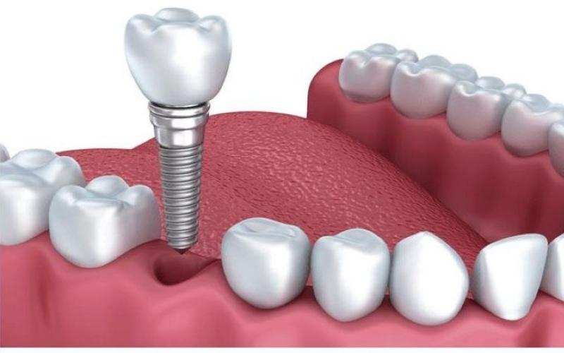 Trồng răng Implant giúp khắc phục tình trạng mất răng hiệu quả